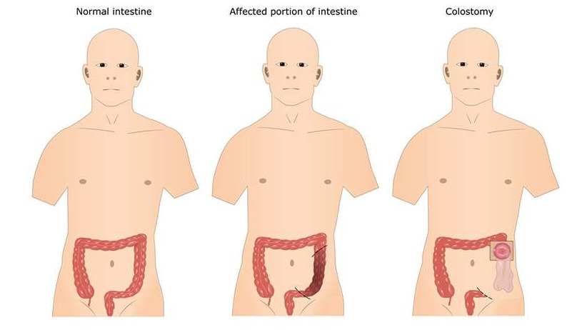 Was ist ein Stoma?