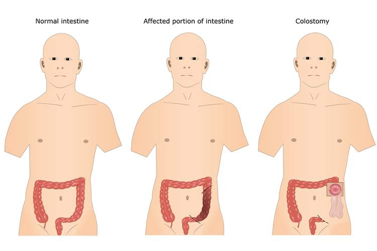 Colostomy surgery for IBD  IBDrelief